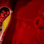 Tiché signály na koži a očiach: Ako odhaliť vysoký cholesterol včas?